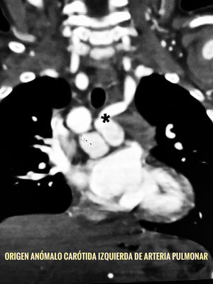 AngioTAC donde se resalta (*) el origen anómalo de la arteria carótida común izquierda desde el tronco de la arteria pulmonar.