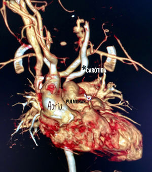Reconstrucción tridimensional de la AngioTAC donde se muestra (*) la anomalía vascular de la carótida común izquierda.