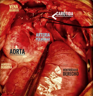 Vista intraoperatoria donde se observan las estructuras cardiovasculares y el origen anómalo de la carótida común izquierda desde la arteria pulmonar.