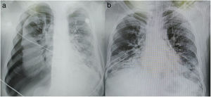 Radiografía de tórax. a) Neumotórax espontáneo derecho. b) Control radiográfico posterior a la colocación de sonda pleural en decúbito prono.