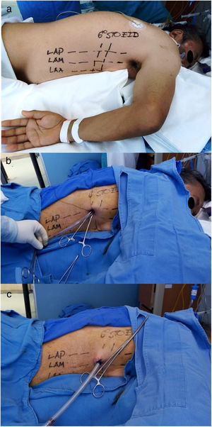 Colocación de drenaje pleural en decúbito prono. a) Posición para protección de antebrazo, demarcación de hemitórax derecho. b) Drenaje torácico guiado con pinza Bozeman (uterina). c) Fijación, posición de tubo drenaje y conexión a unidad de drenaje torácico.
