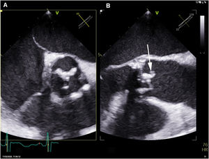 Ecocardiografía transesofágica. A) Eje corto: engrosamiento de los velos de la bioprótesis. B) Tracto de salida del ventrículo izquierdo: masa anclada en el velo de la bioprótesis (flecha).