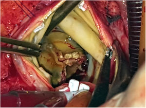 Vista intraoperatoria desde la cabecera del paciente al abrir la aorta ascendente.