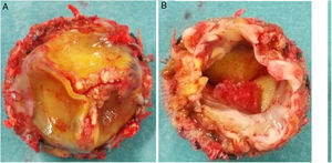 Bioprótesis explantada. A) Cara aórtica: engrosamiento y calcificación de los bordes libres. B) Cara ventricular: gran vegetación sobre los velos de la bioprótesis.