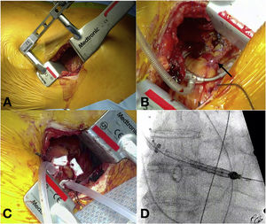 A) Minitoracotomía anterior. B) Estabilizador de tejido epicárdico e injerto de AMII (flecha). C) Bolsa de tabaco con poliprolineno 3/0. D) Colocación de la prótesis.
