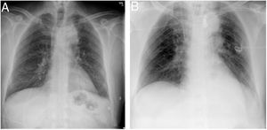 A) Radiografía de tórax preoperatoria que muestra ensanchamiento mediastínico superior. B) Radiografía de tórax postoperatoria que muestra el material quirúrgico aórtico (stent) e inicio de resolución del ensanchamiento mediastínico.