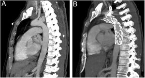 A) Angio-TC de diagnóstico, que muestra tres imágenes excrecentes que dependen de la porción superior del arco aórtico en relación con pseudoaneurismas, en contigüidad con la masa pulmonar ya conocida. B) Angio-TC postoperatoria con la endoprótesis aórtica y la embolización del origen de la arteria subclavia izquierda.