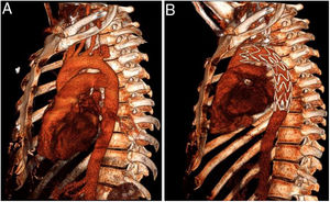 A) Reconstrucción vascular 3D antes de la cirugía. B) Reconstrucción vascular 3 D después de la cirugía TEVAR, que muestra la endoprótesis en el arco aórtico.