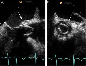 Ecocardiografía transesofágica. A) Proyección longitudinal. B) Proyección transversal. Se aprecia engrosamiento de los velos de la bioprótesis y absceso anular (flecha).