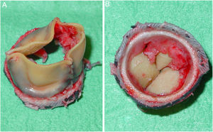Bioprótesis explantada. A) Cara aórtica. B) Cara ventricular. Se aprecia material fibrinohemático con aspecto de pannus en la cara ventricular de la prótesis.
