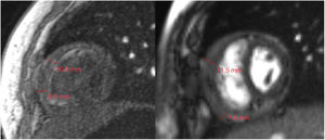 Estudio de resonancia magnética cardiaca donde se aprecia engrosamiento del pericardio de 7,8-11,5mm con restricción de la función biventricular.