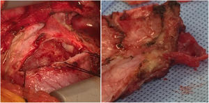 Aspecto macroscópico del pericardio. Se aprecia un pericardio adosado al epicardio, engrosado y fibrótico.