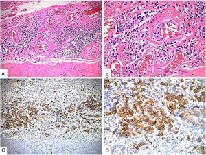 Estudio histopatológico: A.- Aspecto morfológico del tejido pericárdico, en el cual se destaca la presencia de un infiltrado inflamatorio de células mononucleadas en un estroma fibroconectivo denso (tinción de hematoxilina &eosina, 40X). B.- A mayor aumento (100X) se aprecia un número significativo de células plasmáticas entre las células del infiltrado. C y D.- Tinción de inmunohistoquímica con el anticuerpo CD38 resalta la población de células plasmáticas (40X y 100X respectivamente).