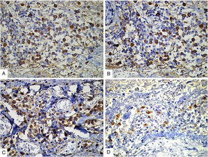 Estudio de inmunohistoquímica: A.- Tinción positiva para cadenas ligeras kappa en el citoplasma de las células plasmáticas y (B) con el anticuerpo para cadenas ligeras lambda, en una proporción similar, los cual demuestra la policlonalidad de la población de células plasmáticas. C.- Inmunotinción positiva difusa con el anticuerpo IgG. D.- Células plasmáticas positivas con IgG4, que corresponden a un 30% de la población de las células positivas con IgG (aproximadamente 20 células positivas por campo de 40X).