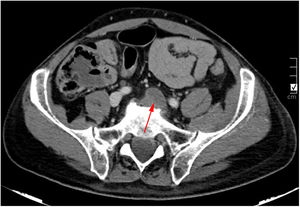 Corte axial de tomografía computarizada con contraste. Trombosis de la vena. iliaca común izquierda (flecha roja). El color de la figura solo puede apreciarse en la versión electrónica del artículo.