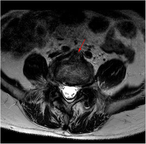 RM axial y coronal T2. Protrusión disco-osteofitaria anterior a nivel de L5-S1 (flechas rojas) con efecto de masa sobre el recorrido de la vena iliaca común izquierda. El color de la figura solo puede apreciarse en la versión electrónica del artículo.