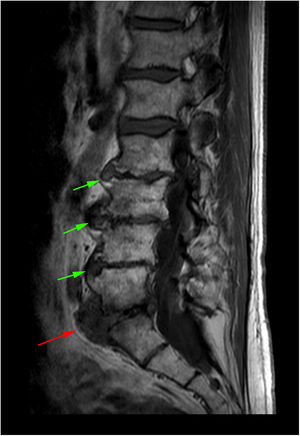 RM axial y coronal T2. Protrusión disco-osteofitaria anterior a nivel de L5-S1 (flechas rojas) con efecto de masa sobre el recorrido de la vena iliaca común izquierda. El color de la figura solo puede apreciarse en la versión electrónica del artículo.
