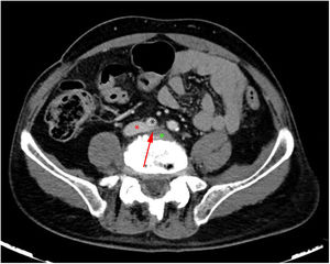 Corte axial de tomografía computarizada con contraste. La salida de la vena (flecha roja) iliaca común izquierda es comprimida (asterisco rojo) entre hernia disco-osteofitaria anterior L5-S1 (asterisco verde) y la arteria iliaca derecha (asterisco negro). El color de la figura solo puede apreciarse en la versión electrónica del artículo.