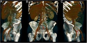 Reconstrucción en 3D. Trombosis de la vena iliaca común izquierda (flecha roja). A) Paquete vascular iliaco derecho con flujo conservado. B y C) Arteria iliaca izquierda con flujo conservado (asterisco rojo) y defecto de repleción en la vena iliaca común izquierda que se origina a nivel de L5-S1 (flecha roja). El color de la figura solo puede apreciarse en la versión electrónica del artículo.
