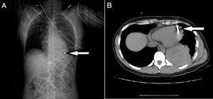 Las flechas señalan la presencia de un cuerpo extraño en el ápex del ventrículo izquierdo (VI) (A: radiografía de tórax) y la perforación del VI por el proyectil (B: TAC de tórax).