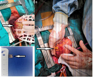 Las flechas señalan el orificio de entrada de la bala en el ventrículo izquierdo (VI) (A), el cierre de la ventriculotomía con doble parche del teflón (B) y la bala de aproximadamente 1cm (C).