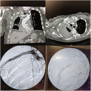 Las dos imágenes superiores corresponden al TC diagnóstico, señalando en la imagen superior izquierda con una flecha verde el pseudoaneurisma de la arteria mamaria interna derecha, posible origen del sangrado. En las dos imágenes inferiores se muestra la angiografía terapéutica, la última con sustracción, en la que se ha pasado la guía por la mamaria y por su rama afectada. El color de la figura solo puede apreciarse en la versión electrónica.