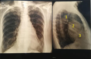 Radiografía de tórax. Izq. Frente no se observan anomalías. Der. En el perfil, 1) aorta ascendente cayado y aorta descendente, 2) aneurisma de raíz aórtica, 3) ventrículo. Se observan 6 alambres esternales.