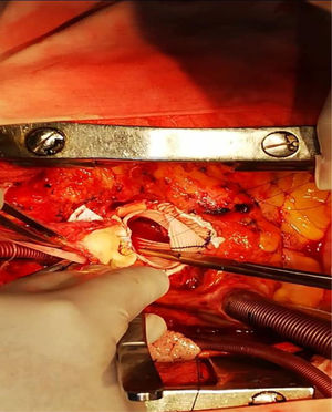 Se sutura tubo de Dacrón a aorta ascendente porción distal.