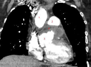 Control postoperatorio.1) Aorta ascendente. 2) Arteria pulmonar. 3) Raíz aortica. 4) Región donde se encontraba antes el aneurisma donde actualmente no se observa contraste.