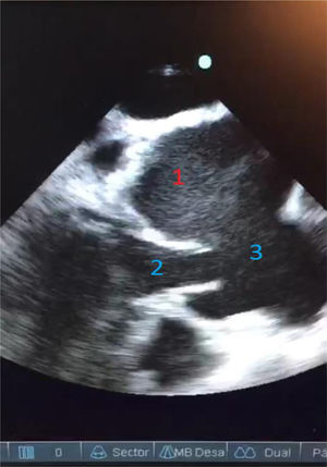 Ecocardiograma donde se observa: 1) Aneurisma de seno de Valsalva izquierdo. 2) Plano valvular aórtico con apertura de válvula aórtica. 3) Aorta ascendente.
