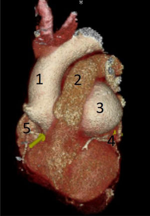 Reconstrucción de tomografía donde se observa gran ASV izquierdo por detrás de la arteria pulmonar y por delante de la aurícula izquierda. 1) Aorta ascendente. 2) Tronco de arteria pulmonar. 3) ASV izquierdo. 4) Arteria coronaria izquierda. 5) Arteria coronaria derecha. ASV: aneurisma de seno de Valsalva.