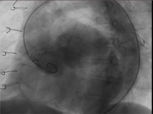 . Cateterismo cardiaco donde se puede observar en la raíz aórtica severa dilatación de SVI. SVI: seno de Valsalva izquierdo.