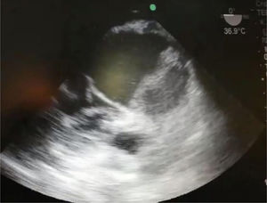 Se observa gran aneurisma asociado a hematoma.