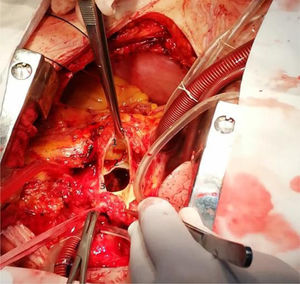 Aortotomía donde se observa: 1) Coronaria derecha. 2) Válvula aórtica. 3) Cuello de aneurisma de seno de Valsalva y, en el fondo, coronaria izquierda.