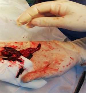 Hematoma extraído del aneurisma.