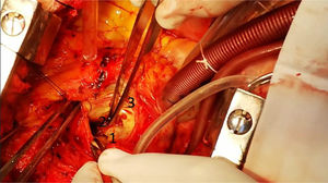 1) Ostium de coronaria izquierda. 2) Una vez extraído el hematoma, se observa la pared aórtica con lecho sanioso en vías de fistulizar. 3) Válvula aórtica.