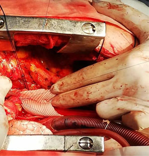 Se observa el implante de la coronaria izquierda en prótesis de Dacrón.