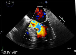 Ecocardiografía transesofágica en modo doppler. Se evidencia aceleración del flujo en el tracto de salida del ventrículo izquierdo.