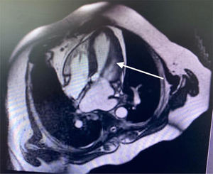 Cardiorresonancia magnética.Flecha blanca: se observa imagen compatible con músculo papilar gigante que se dirige hacia el velo anterior de la válvula mitral.