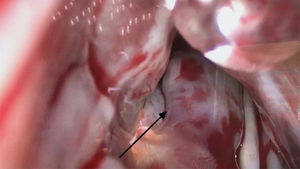 Exploración del ventrículo izquierdo mediante toracoscopio. Flecha negra: músculo papilar aberrante insertado directamente en el velo anterior de la válvula mitral, y que junto con la rodilla septal deja un tracto de salida del ventrículo izquierdo inferior a 1cm2.