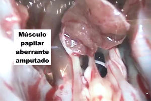Resección y amputación del músculo papilar aberrante gigante.