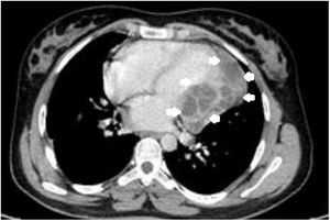 The thoracic computed tomography revealing cardiac cyst (arrows).