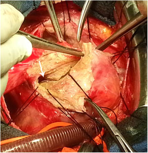 The resection of the dome of the cyst and the longitudinal left ventriculotomy (arrow).