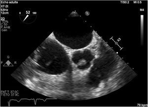 Transoesophageal echocardiogram of 14×8mm mass attached to the free edge of a right coronary cusp.