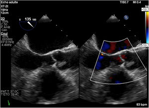 Transesophageal echocardiography reveals a 14×8mm mass on the aortic valve.
