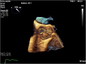 3D echocardiography of the mass attached to the aortic valve.