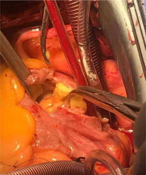 Canulacion bicaval y auriculotomía con tumor adherido a la base de la aurícula derecha. Imagen en sentido caudo-cefálico.