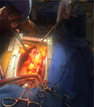 Extensión del tumor al mediastino, una vez liberado de la base de la aurícula derecha. Imagen en sentido caudocefálico.