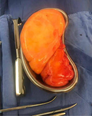 Lipoma extirpado, se observa bilobulado, bien delimitado, contenido homogéneo.