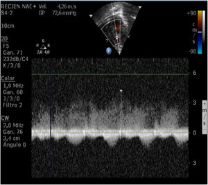 Continuous Doppler-ultrasound. It shows a pulsatile sistodiastolic flow with 4m/s of velocity and a gradient of 72.6mmHg, compatible with fistula.